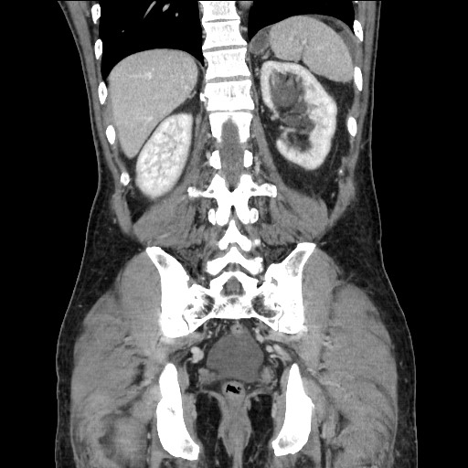 Closed loop small bowel obstruction - omental adhesion causing "internal hernia" (Radiopaedia 85129-100682 B 95).jpg