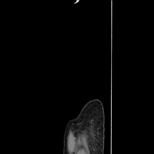 Closed loop small bowel obstruction - omental adhesion causing "internal hernia" (Radiopaedia 85129-100682 C 182).jpg