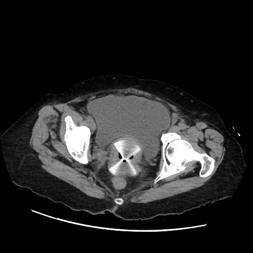 Closed loop small bowel obstruction due to adhesive band, with intramural hemorrhage and ischemia (Radiopaedia 83831-99017 Axial non-contrast 144).jpg