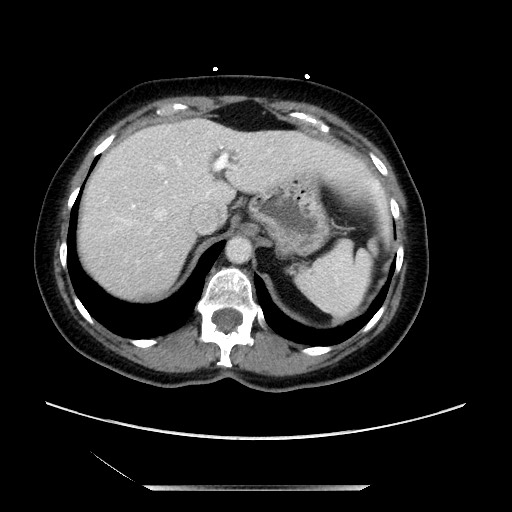 File:Closed loop small bowel obstruction due to adhesive bands - early and late images (Radiopaedia 83830-99014 A 24).jpg