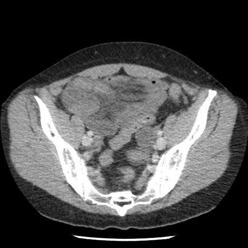 Closed loop small bowel obstruction due to trans-omental herniation (Radiopaedia 35593-37109 A 69).jpg