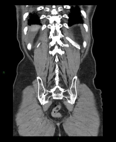 File:Closed loop small bowel obstruction with ischemia (Radiopaedia 84180-99456 B 8).jpg