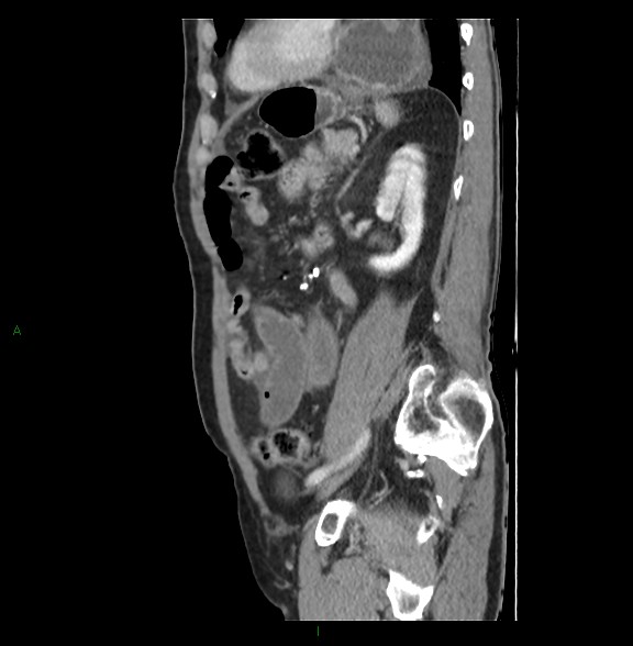 File:Closed loop small bowel obstruction with ischemia (Radiopaedia 84180-99456 C 63).jpg