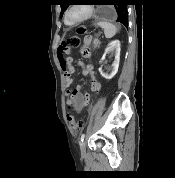 Closed loop small bowel obstruction with ischemia (Radiopaedia 84180-99456 C 67).jpg