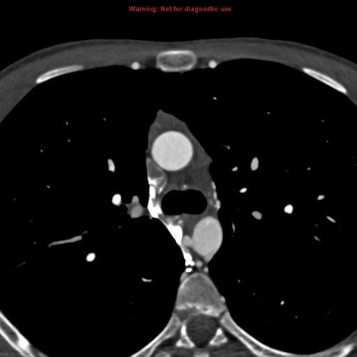 File:Coarctation of the aorta (Radiopaedia 12461-12697 A 132).jpg
