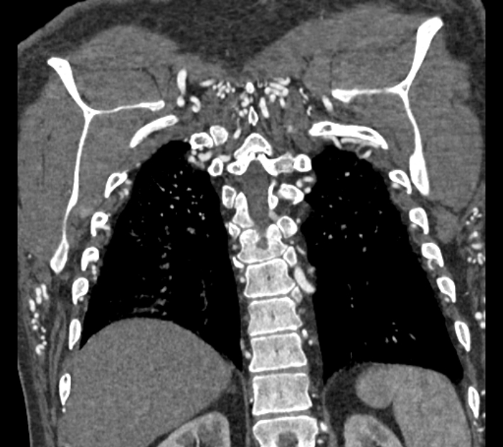Coarctation of the aorta (Radiopaedia 53752-59822 B 66).jpg