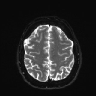 Cochlear incomplete partition type III associated with hypothalamic hamartoma (Radiopaedia 88756-105498 Axial DWI 32).jpg
