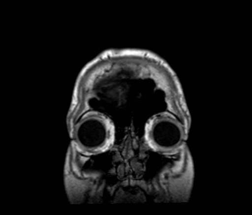Cochlear incomplete partition type III associated with hypothalamic hamartoma (Radiopaedia 88756-105498 Coronal T1 59).jpg