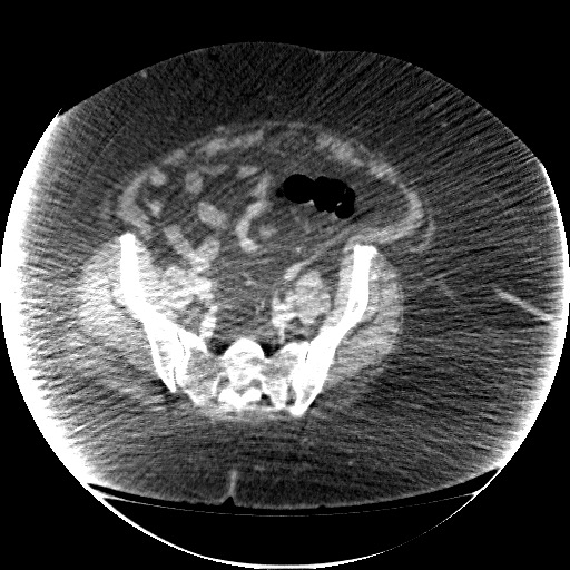 File:Collection due to leak after sleeve gastrectomy (Radiopaedia 55504-61972 A 63).jpg