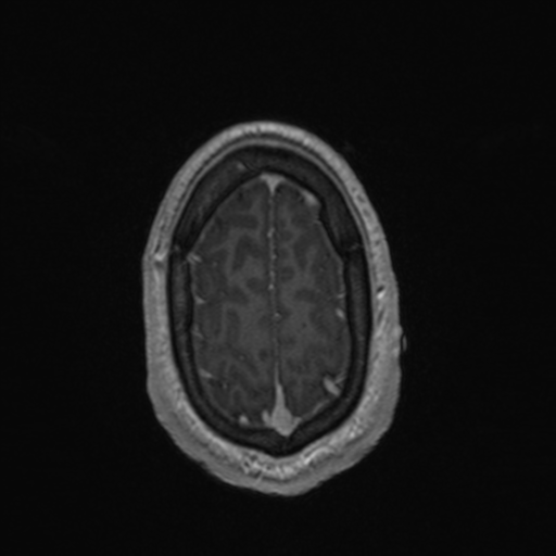File:Colloid cyst (Radiopaedia 44510-48181 Axial T1 C+ 159).png