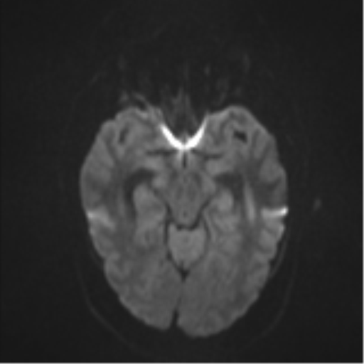 File:Colloid cyst (Radiopaedia 53164-59125 Axial DWI 38).png