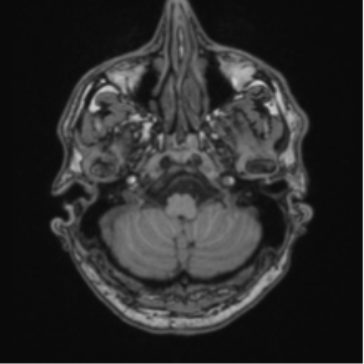 File:Colloid cyst of the third ventricle (Radiopaedia 86571-102662 Axial T1 16).png