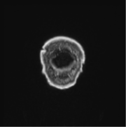 Colloid cyst of the third ventricle (Radiopaedia 86571-102662 Coronal T1 C+ 2).png