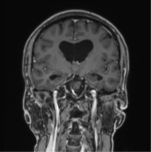 File:Colloid cyst of the third ventricle (Radiopaedia 86571-102662 Coronal T1 C+ 51).png