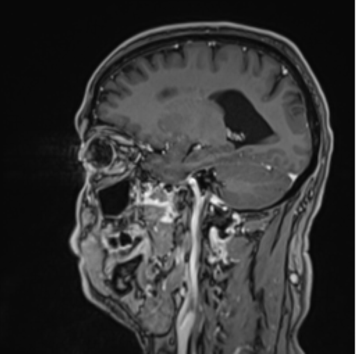 File:Colloid cyst of the third ventricle (Radiopaedia 86571-102662 Sagittal T1 C+ 26).png