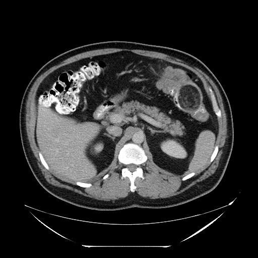 Colocolic intussusception due to lipoma (Radiopaedia 73712-84508 A 36).jpg