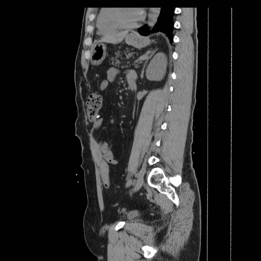 File:Colocutaneous fistula in Crohn's disease (Radiopaedia 29586-30093 C 35).jpg