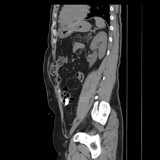 File:Colocutaneous fistula in Crohn's disease (Radiopaedia 29586-30093 F 32).jpg