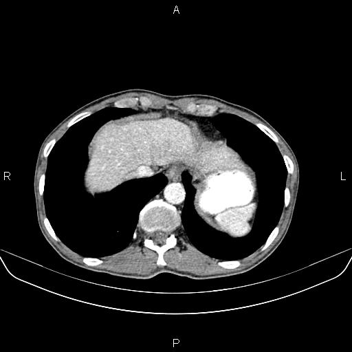 Colon adenocarcinoma - hepatic flexure (Radiopaedia 85635-101395 A 13).jpg