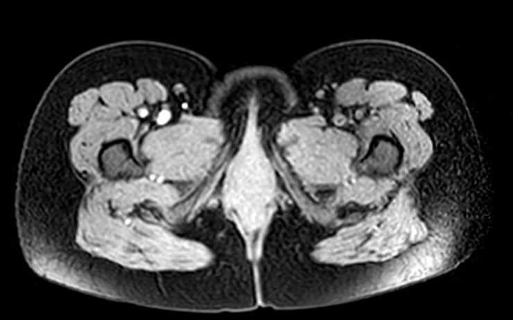 Colon adenocarcinoma with Krukenberg tumors, advanced pregnancy (Radiopaedia 67279-76645 A 1).jpg