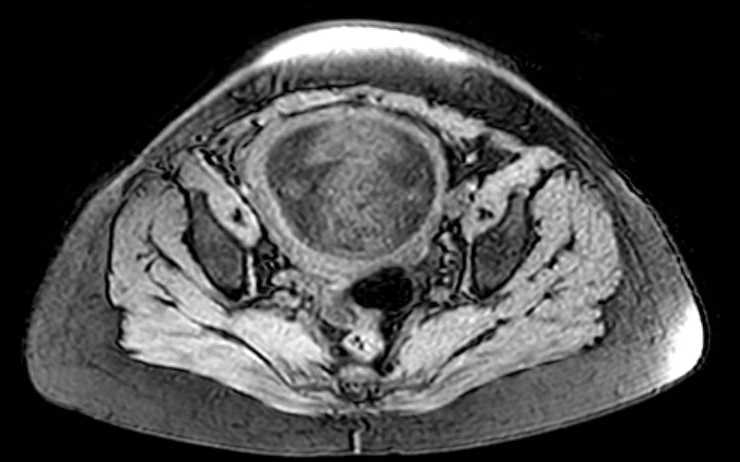 Colon adenocarcinoma with Krukenberg tumors, advanced pregnancy (Radiopaedia 67279-76645 A 18).jpg
