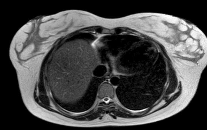 Colon adenocarcinoma with Krukenberg tumors, advanced pregnancy (Radiopaedia 67279-76645 Axial T2 79).jpg