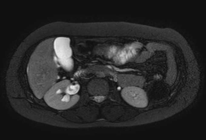 Colon adenocarcinoma with Krukenberg tumors, advanced pregnancy (Radiopaedia 67279-76645 Axial T2 SPAIR 50).jpg