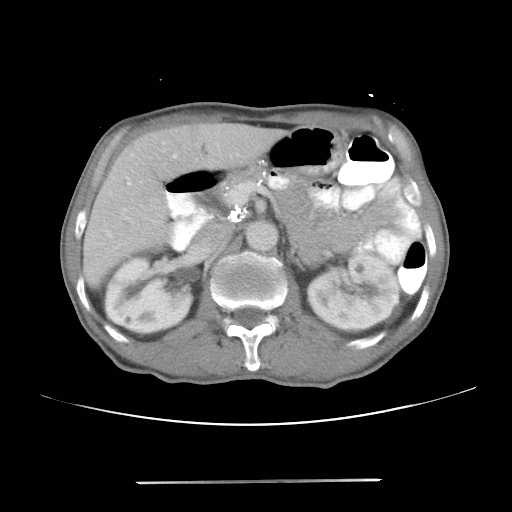 Colon cancer with calcified liver metastasis (Radiopaedia 74423-85307 A 26).jpg