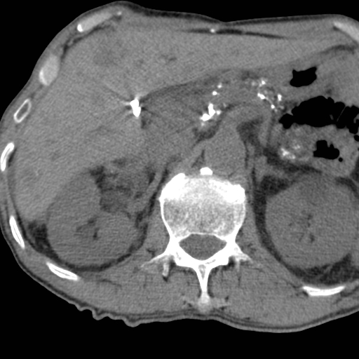 Colon cancer with calcified liver metastasis (Radiopaedia 74423-85309 Axial non-contrast 31).jpg