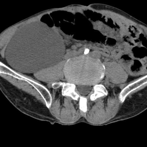 Colon cancer with calcified liver metastasis (Radiopaedia 74423-85309 Axial non-contrast 68).jpg