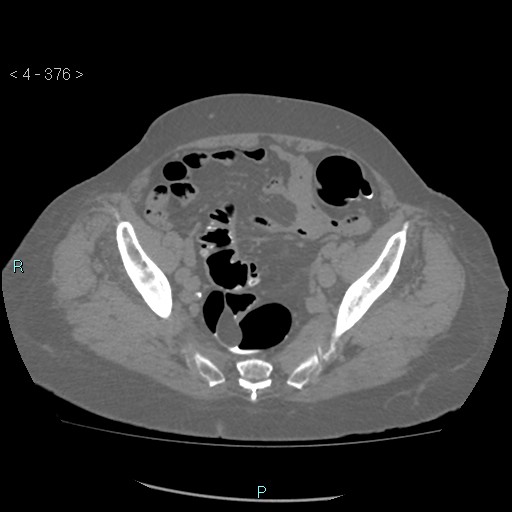 File:Colonic lipomas (Radiopaedia 49137-54244 Axial bone window 168).jpg