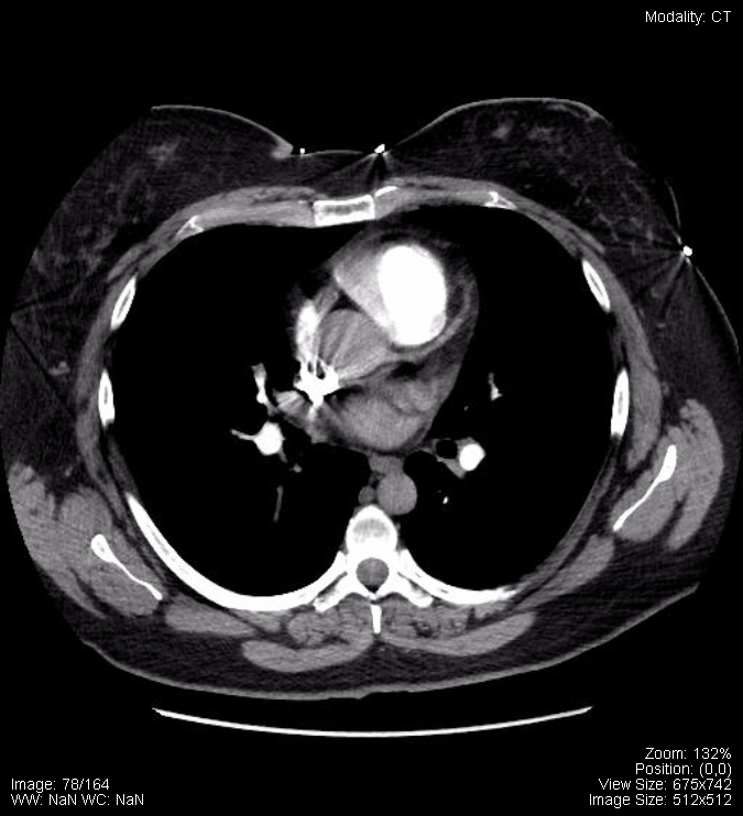 Fig 17.40B Normal CTA of Chest.png