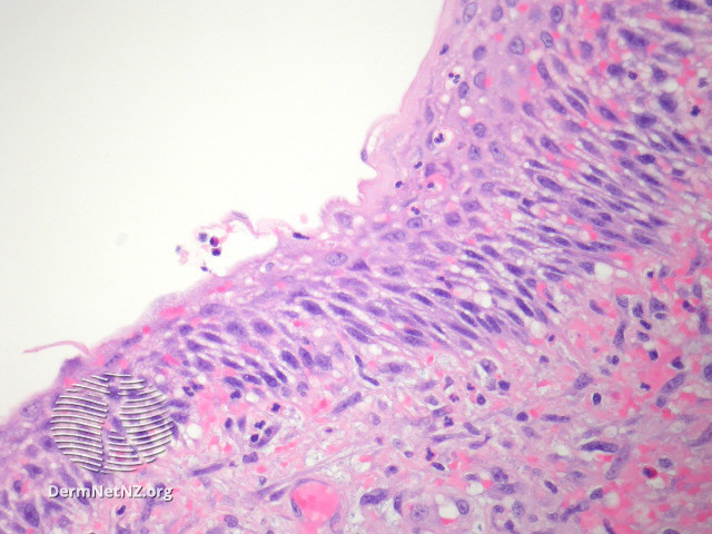 File:Figure 2 (DermNet NZ pathology-e-branchial-cleft-cyst-figure-2).jpg