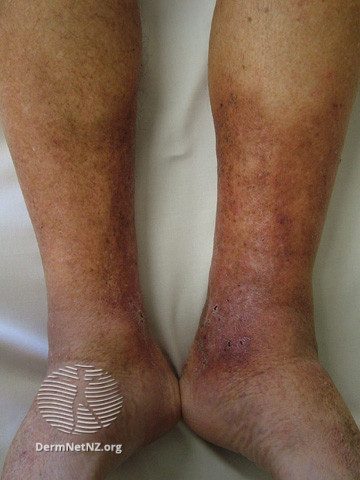 File:Lipodermatosclerosis (DermNet NZ vascular-lds6).jpg