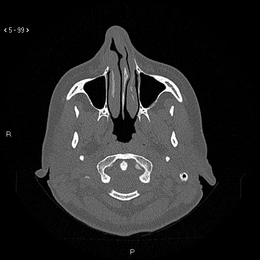 Nasolabial cyst (Radiopaedia 75125-86194 Axial bone window 60).jpg