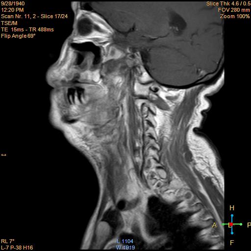 File:Nasopharyngeal carcinoma (Radiopaedia 22375-22403 Sagittal T1 C+ 11).jpg