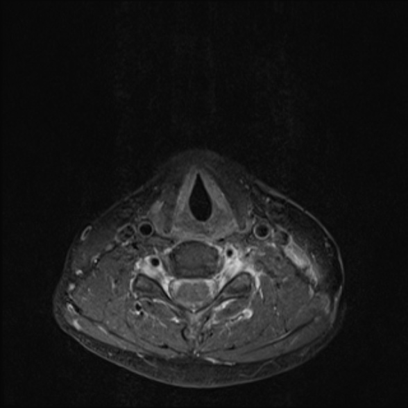 Nasopharyngeal carcinoma with skull base invasion (Radiopaedia 53415-59485 Axial T1 C+ fat sat 58).jpg