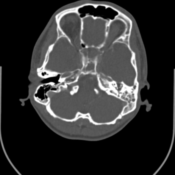 Nasopharyngeal carcinoma with skull base invasion (Radiopaedia 53415-59705 Axial bone window 12).jpg