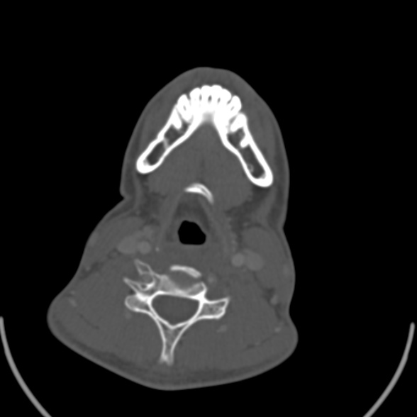 Nasopharyngeal carcinoma with skull base invasion (Radiopaedia 53415-59705 Axial bone window 138).jpg