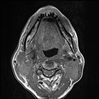 Nasopharyngeal carcinoma with skull base invasion (Radiopaedia 59258-66600 B 38).jpg