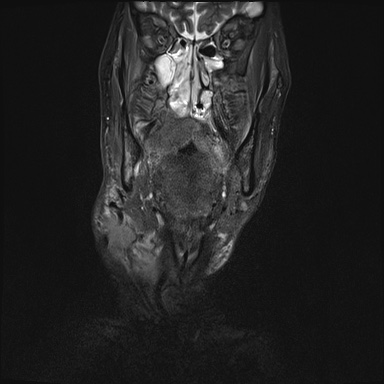 Nasopharyngeal carcinoma with skull base invasion (Radiopaedia 59258-66600 Coronal T2 fat sat 26).jpg
