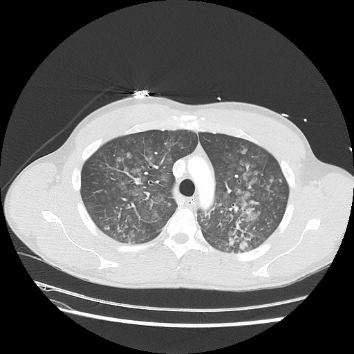 Near-drowning pulmonary edema (Radiopaedia 59457-66814 Axial lung window 17).jpg