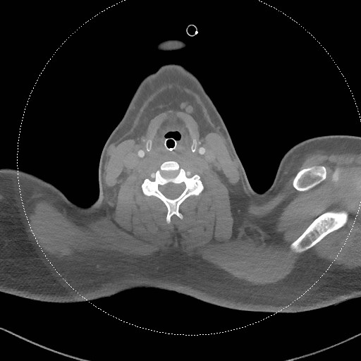 Neck CT angiogram (intraosseous vascular access) (Radiopaedia 55481-61945 B 168).jpg