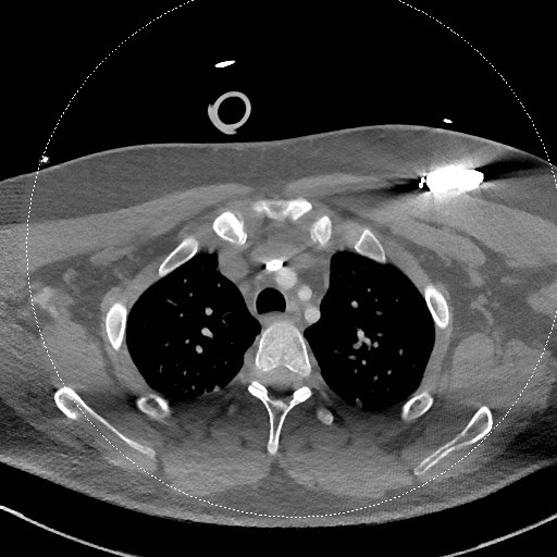 Neck CT angiogram (intraosseous vascular access) (Radiopaedia 55481-61945 B 67).jpg