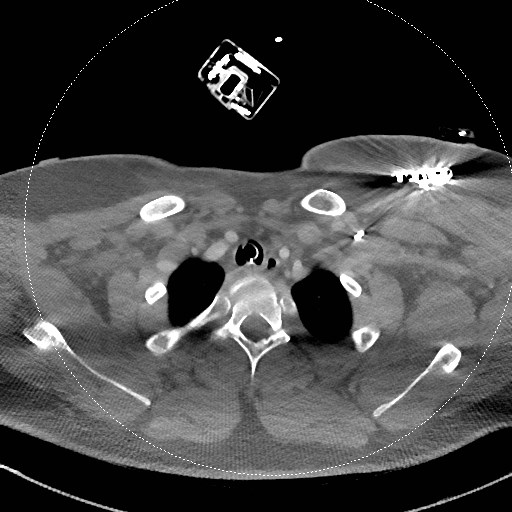 Neck CT angiogram (intraosseous vascular access) (Radiopaedia 55481-61945 B 95).jpg