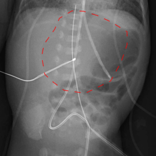 File:Neonatal bowel perforation (Radiopaedia 23839-23999 B 1).jpg