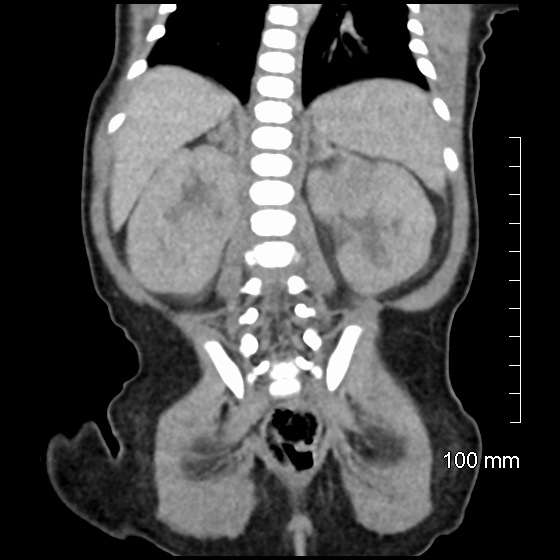 File:Neonatal neuroblastoma (Radiopaedia 56651-63438 Coronal non-contrast 37).jpg
