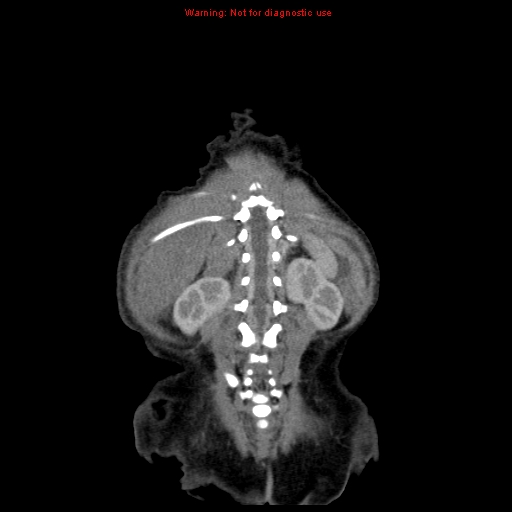 File:Neonatal neuroblastoma (Radiopaedia 9564-10223 B 102).jpg