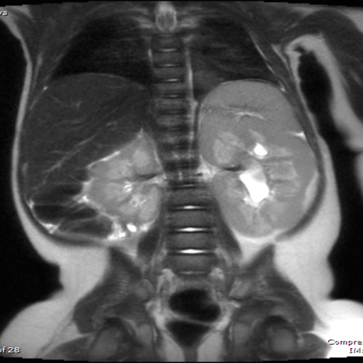 File:Nephroblastomatosis (Radiopaedia 39984-42477 Coronal T2 1).png