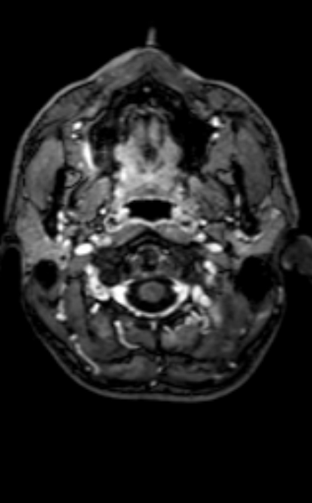 Neuro-Behçet disease (Radiopaedia 90112-107294 Axial T1 C+ 202).jpg